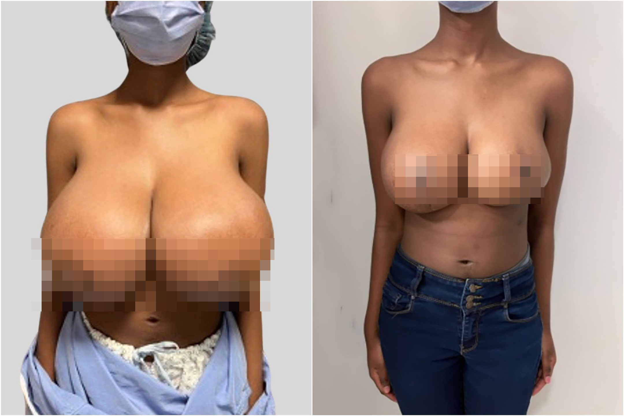 Die Covid-Impfung lässt die Brüste einer 19-Jährigen explodieren: In sechs Monaten geht sie von der dritten in die elfte Klasse