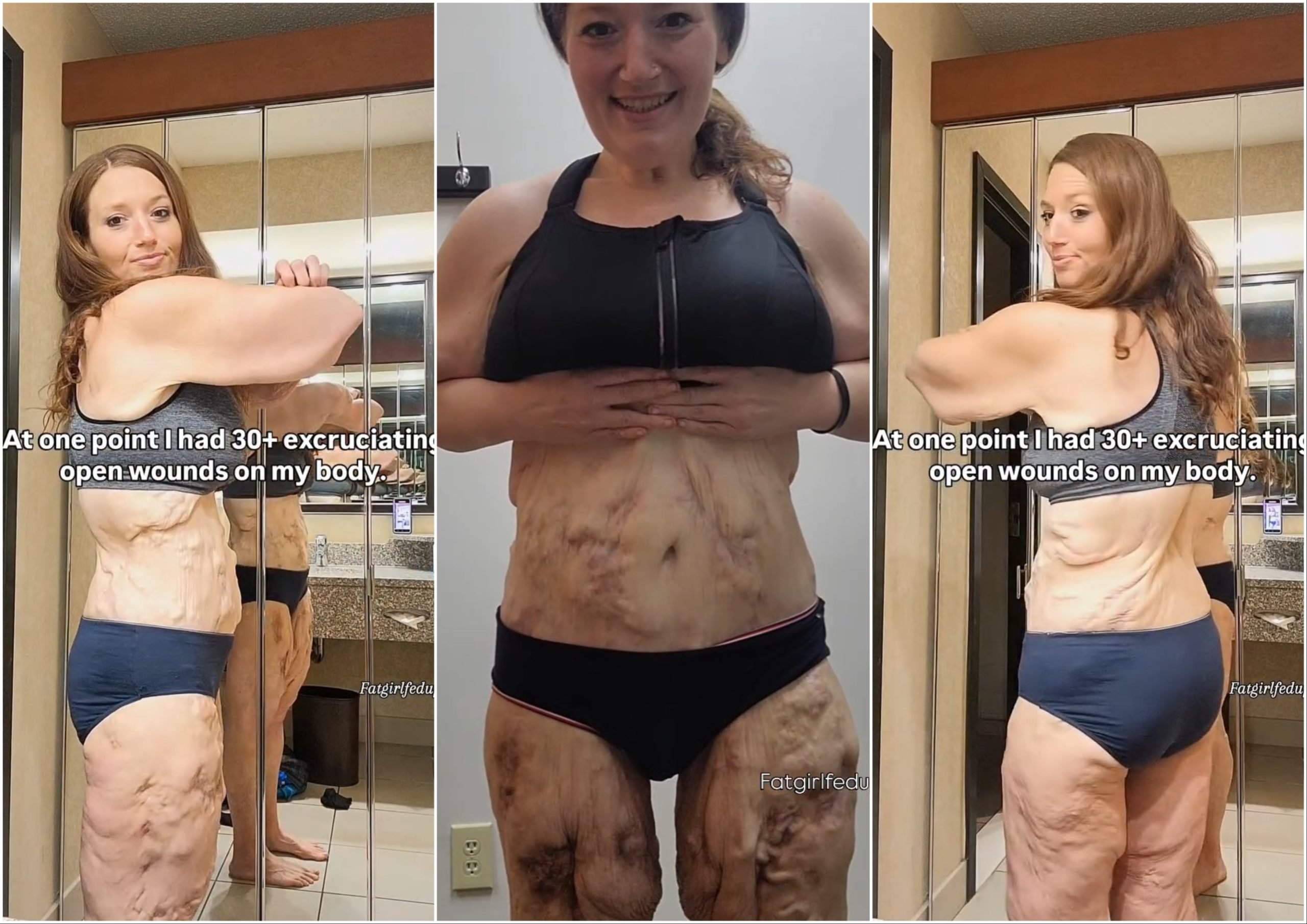 Influencer dietética pierde 140 kg pero una enfermedad de la piel la marca para siempre