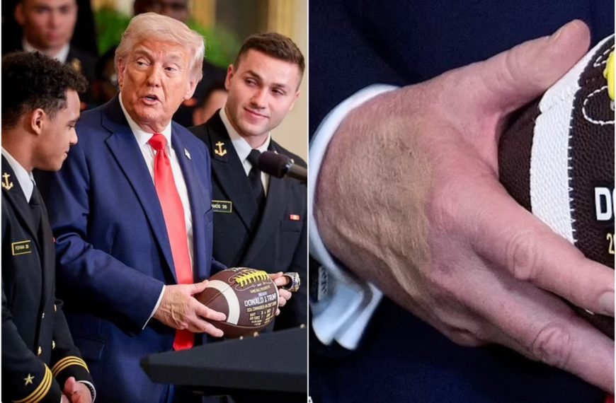 Donald Trump und der mysteriöse Bluterguss an seiner Hand: Der Fleck kehrt zurück und der Verdacht wächst