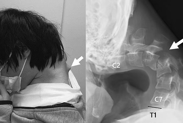 Il joue 8 heures par jour sur son téléphone portable : maintenant, il ne peut plus garder la tête haute