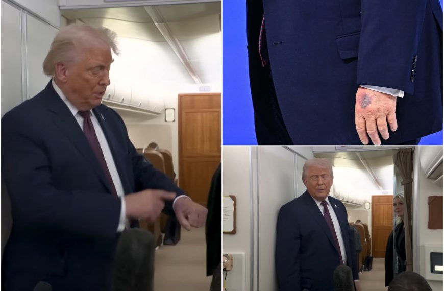 El misterioso moretón que Trump recibió en Davos: esto es lo que es